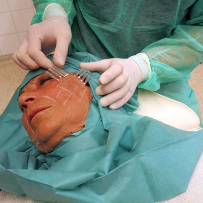 Auch bei minimalinvasiven Maßnahmen wie dem Fadenlifting ist auf die richtige Hygiene zu achten. Mit einem Fadenlifting lässt sich die Haut der Wangen deutlich straffen und aufpolstern.