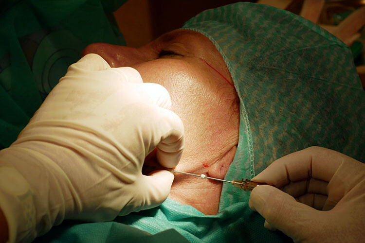 Fadenlifting (Online-Schulung für Ärzte)