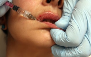 Hyaluronsäure-Filler können zum Volzmenaufbau der Lippen eingesetzt werden.