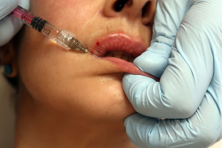 Hyaluronsäure-Filler können zum Volzmenaufbau der Lippen eingesetzt werden.