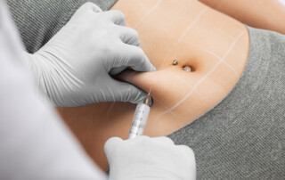 Mit der Injektions-Lipolyse können im Gesicht und am Körper Fettpolster abgebaut werden.