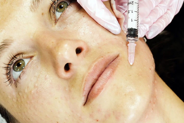 Mit der Mesotherapie kann die Haut durch eine Kombination aus mechnaischem Verfahren und Wirkstoff-Injektionen aufgefrischt und verjüngt werden.