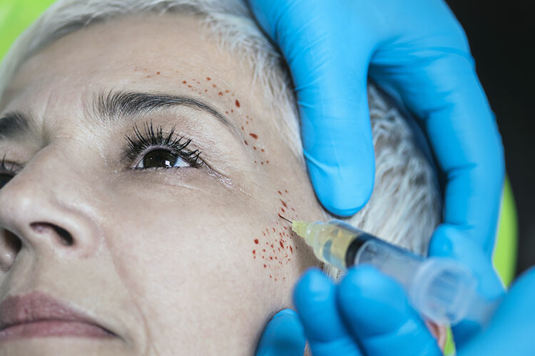 PRP (Regenerative Verfahren 3 – Online-Schulung)